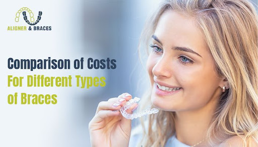 Comparison Of Costs For Different Types Of Braces