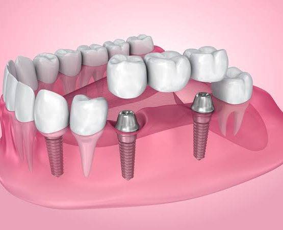 Dental Implants in Delhi