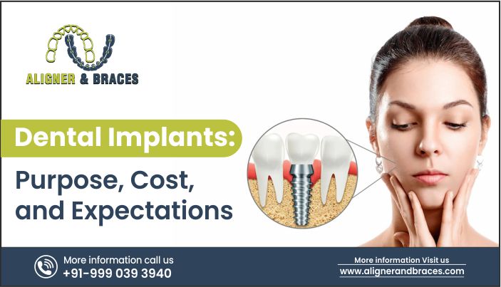 Dental Implants: Purpose, Cost, And Expectations